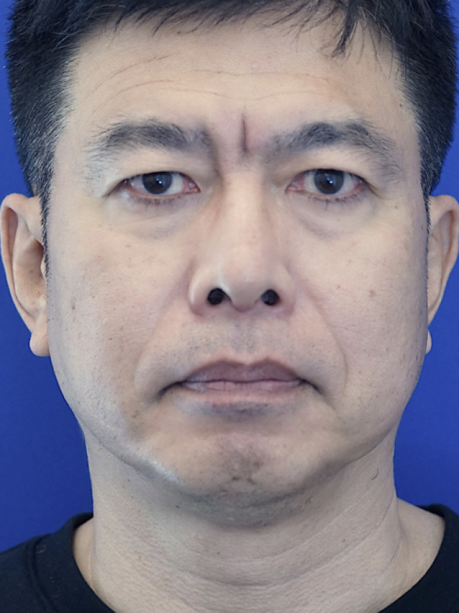 Lower Facial Rejuvenation