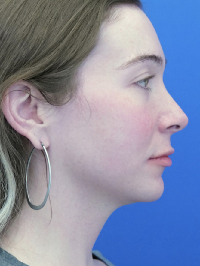 Soften Nasal Contour