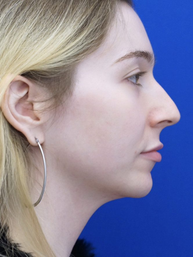 Soften Nasal Contour