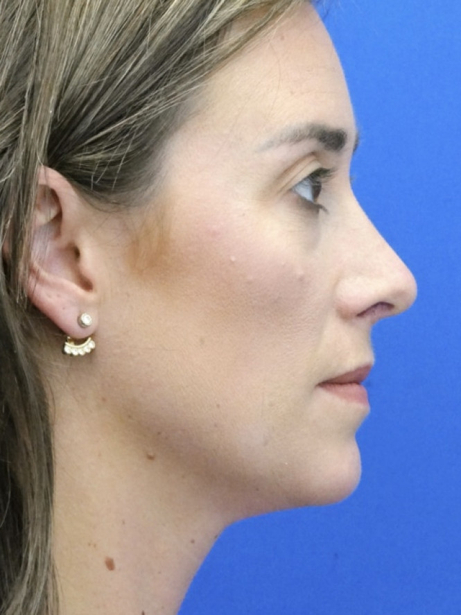 Preservation Rhinoplasty