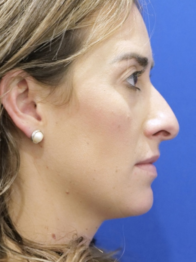 Preservation Rhinoplasty