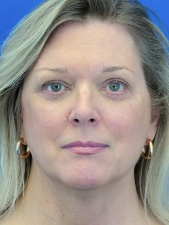 Endoscopic Browlift, Quad Blepharoplasty