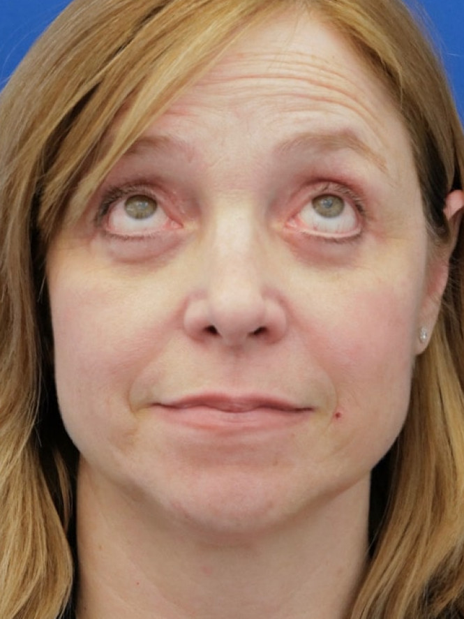 Upper and Lower Blepharoplasty