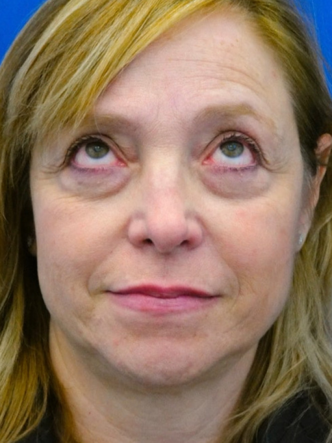 Upper and Lower Blepharoplasty