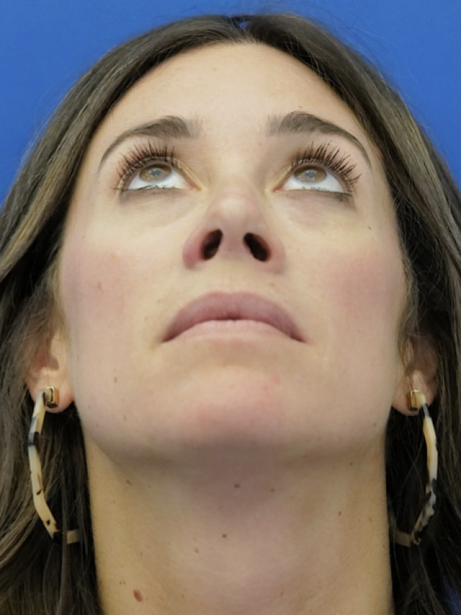 Preservation Rhinoplasty