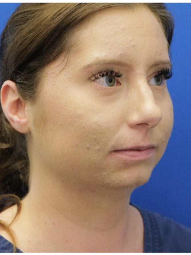 Chin Augmentation and Liposuction