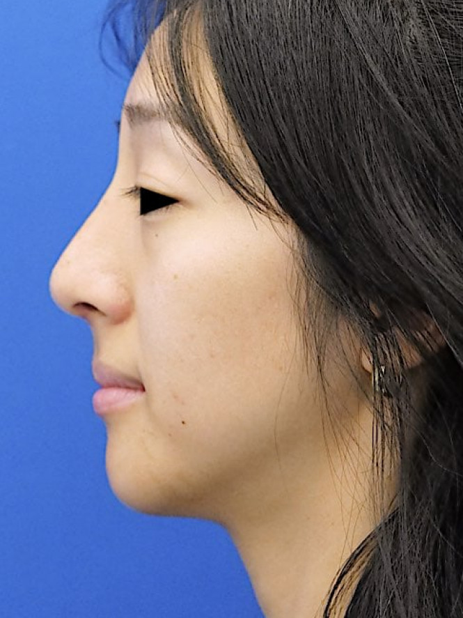 Preservation Ethnic Rhinoplasty