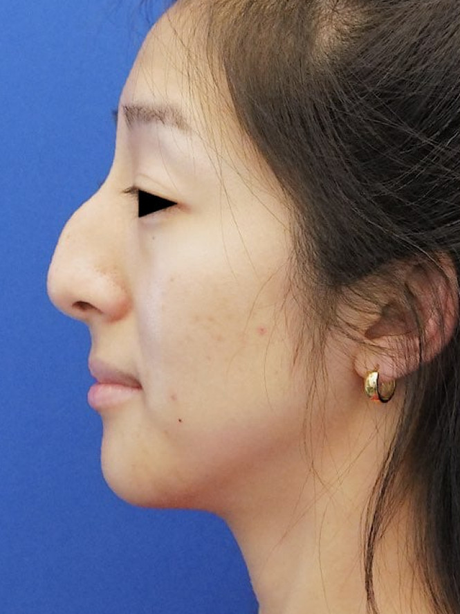 Preservation Ethnic Rhinoplasty