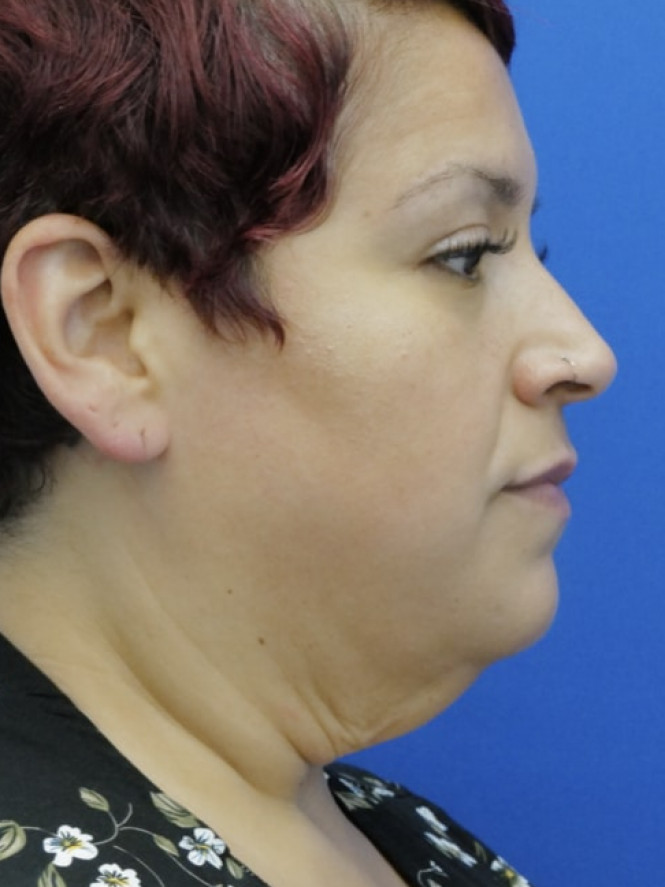 Necklift and Lower Facelift