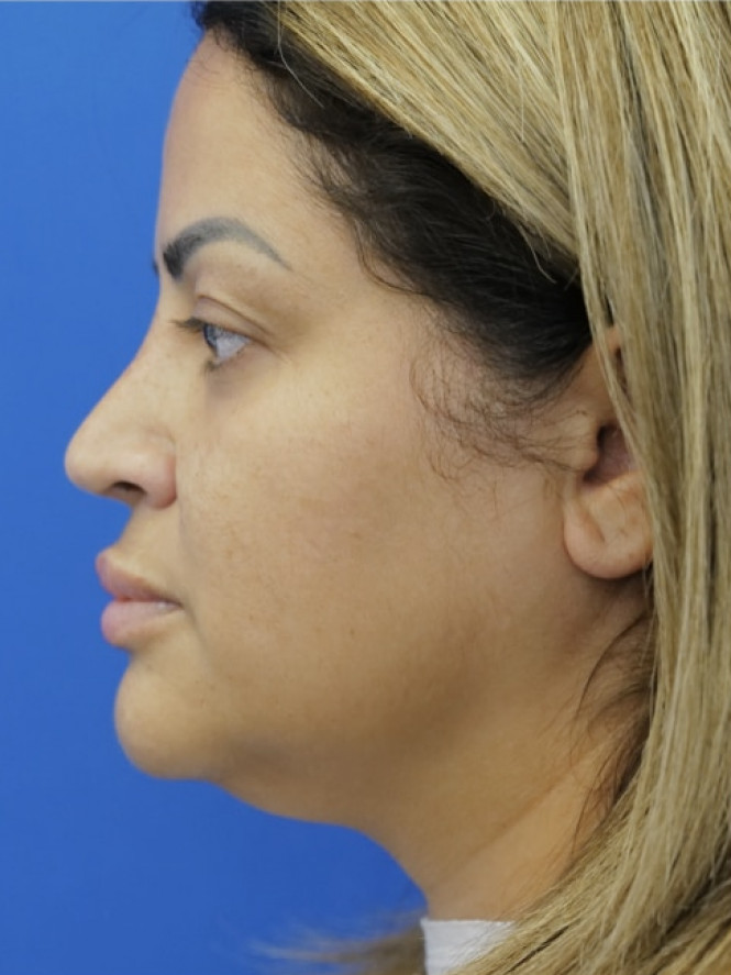 Narrow Nostril Base