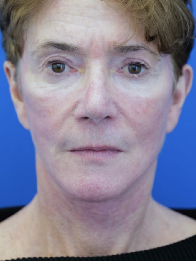 Deep Plane Facelift and Eyelid Lift