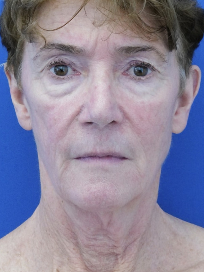 Deep Plane Facelift and Eyelid Lift