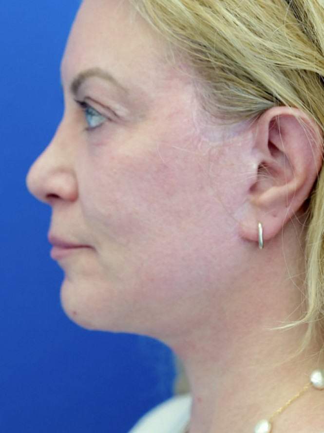 Lower Facial and Neck Fullness