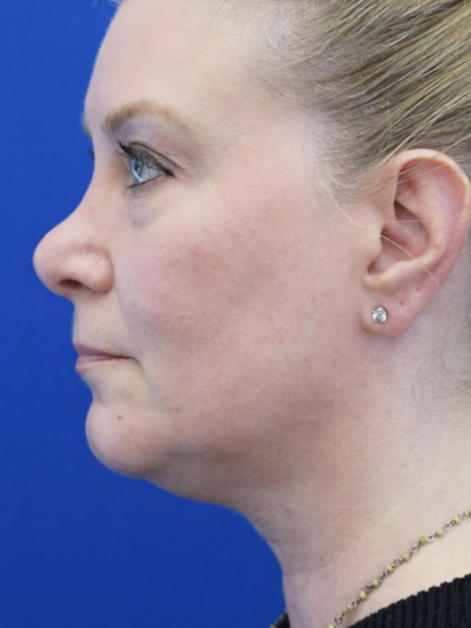 Lower Facial and Neck Fullness