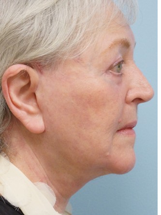 Aging Eyelid, Facelift, Necklift, Fractional CO2 Laser Resurfacing*