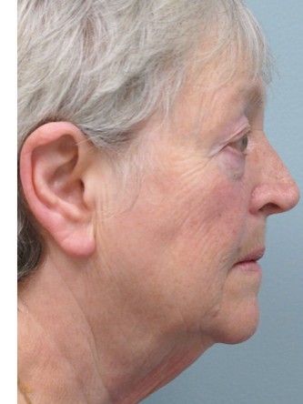 Aging Eyelid, Facelift, Necklift, Fractional CO2 Laser Resurfacing*