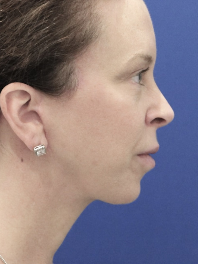 Jowling and Skin Laxity