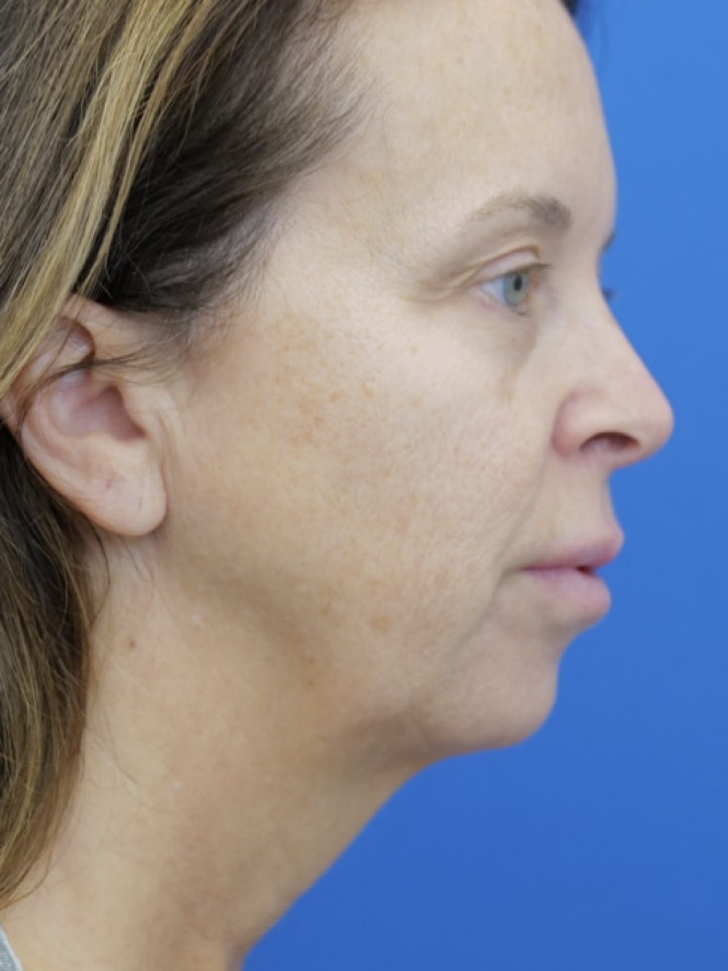 Jowling and Skin Laxity