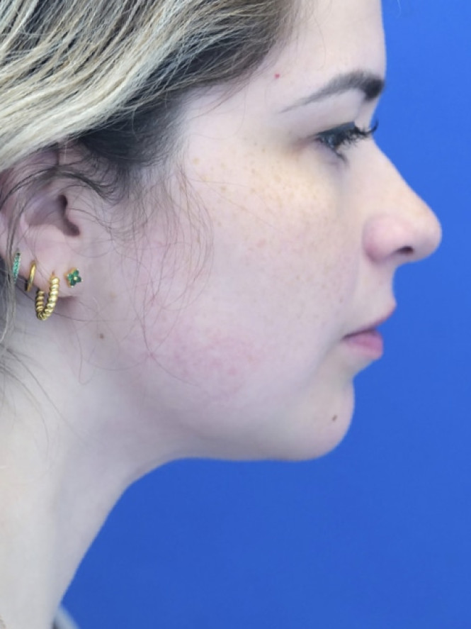 Underchin Fullness