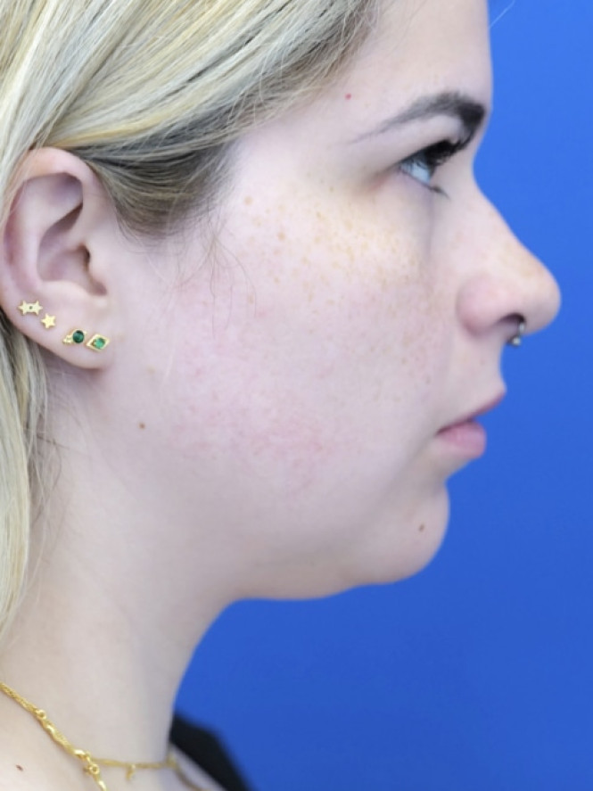 Underchin Fullness