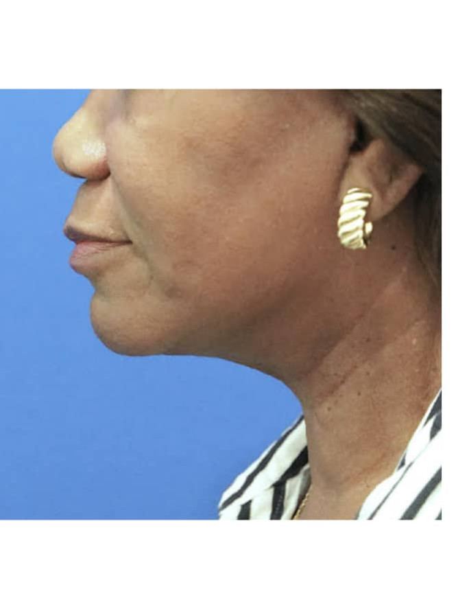 Necklift with Platysmaplasty after photo. Individual results may vary.