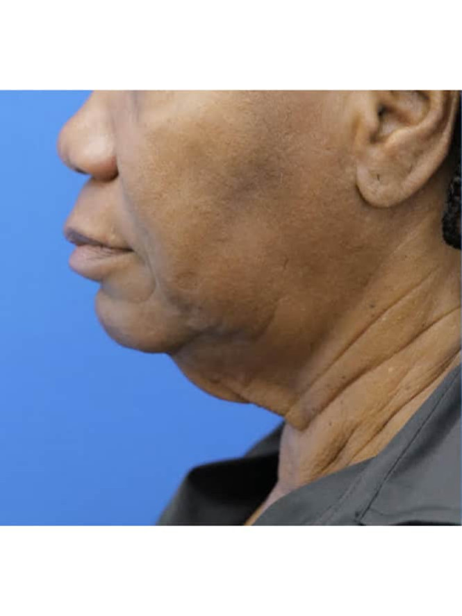 Necklift with Platysmaplasty before photo. Individual results may vary.