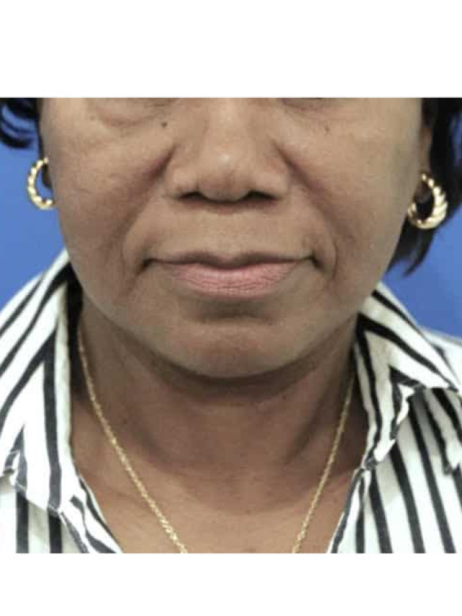 Necklift with Platysmaplasty after photo. Individual results may vary.