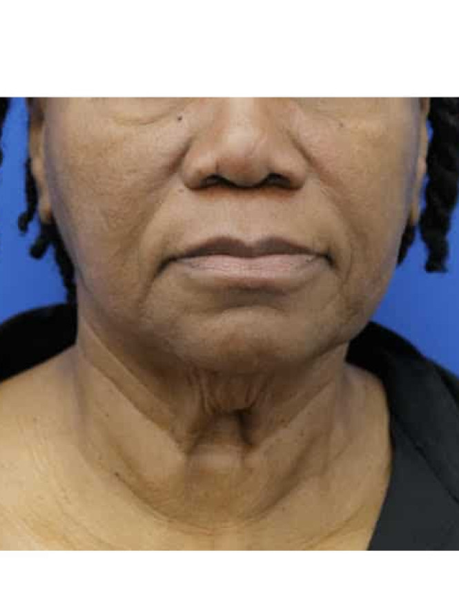 Necklift with Platysmaplasty before photo. Individual results may vary.