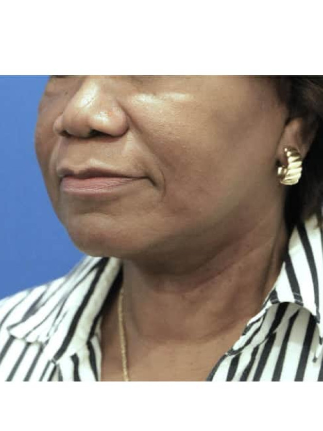 Necklift with Platysmaplasty