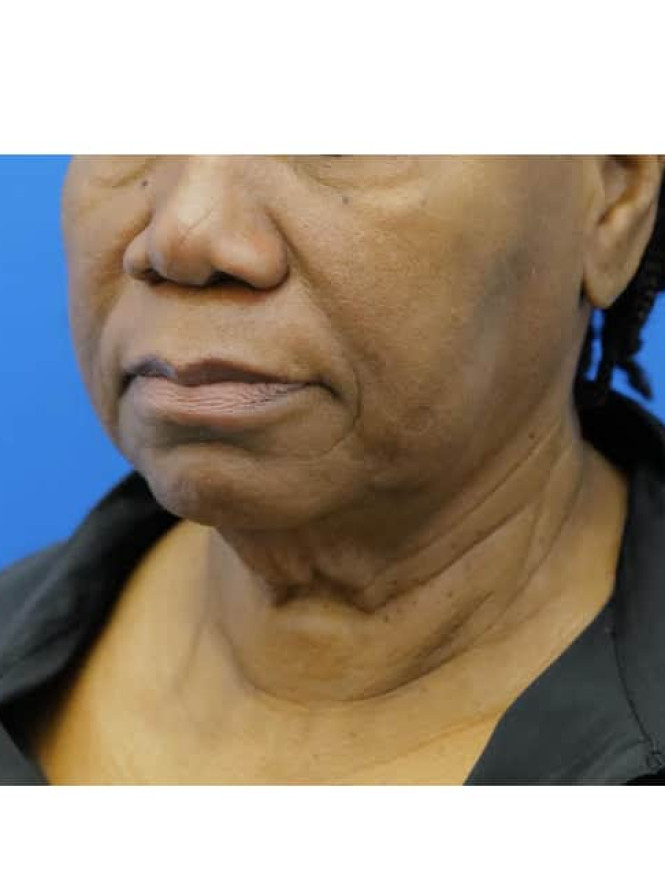 Necklift with Platysmaplasty