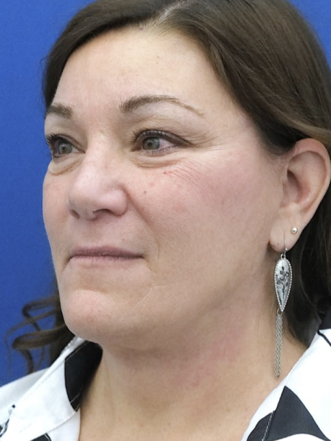 Full Upper and Lower Facelift after photo. Individual results may vary.