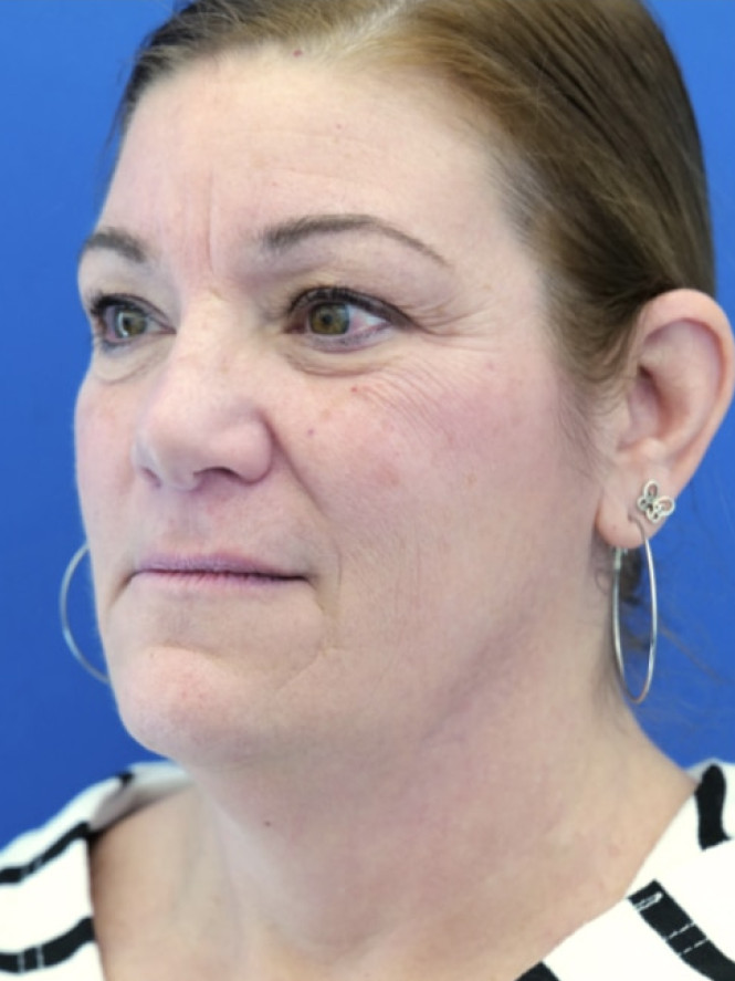 Full Upper and Lower Facelift before photo. Individual results may vary.