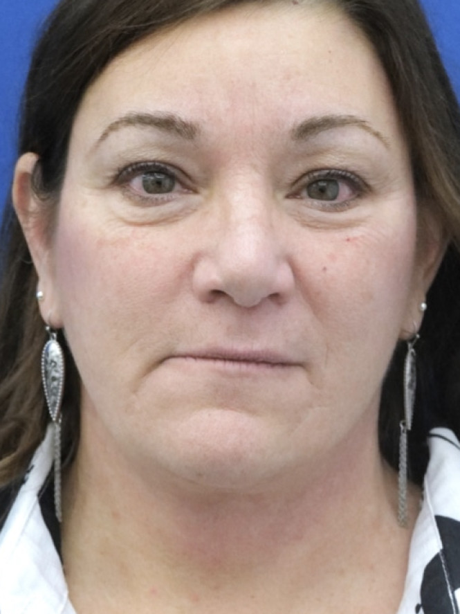 Full Upper and Lower Facelift