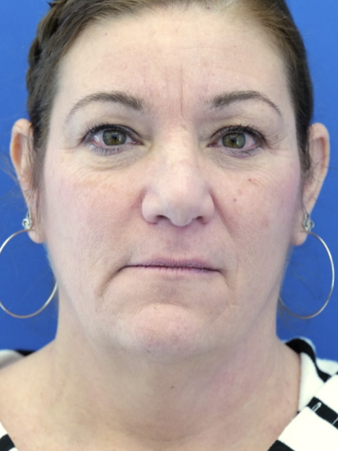 Full Upper and Lower Facelift