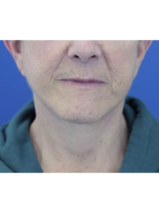 Neck Tissue Laxity after photo. Individual results may vary.