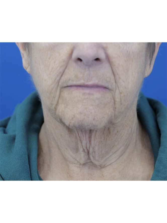 Neck Tissue Laxity before photo. Individual results may vary.