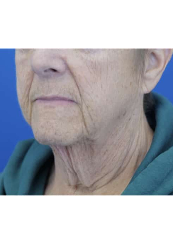 Neck Tissue Laxity before photo. Individual results may vary.