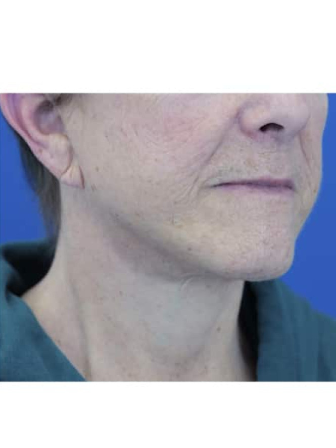 Neck Tissue Laxity