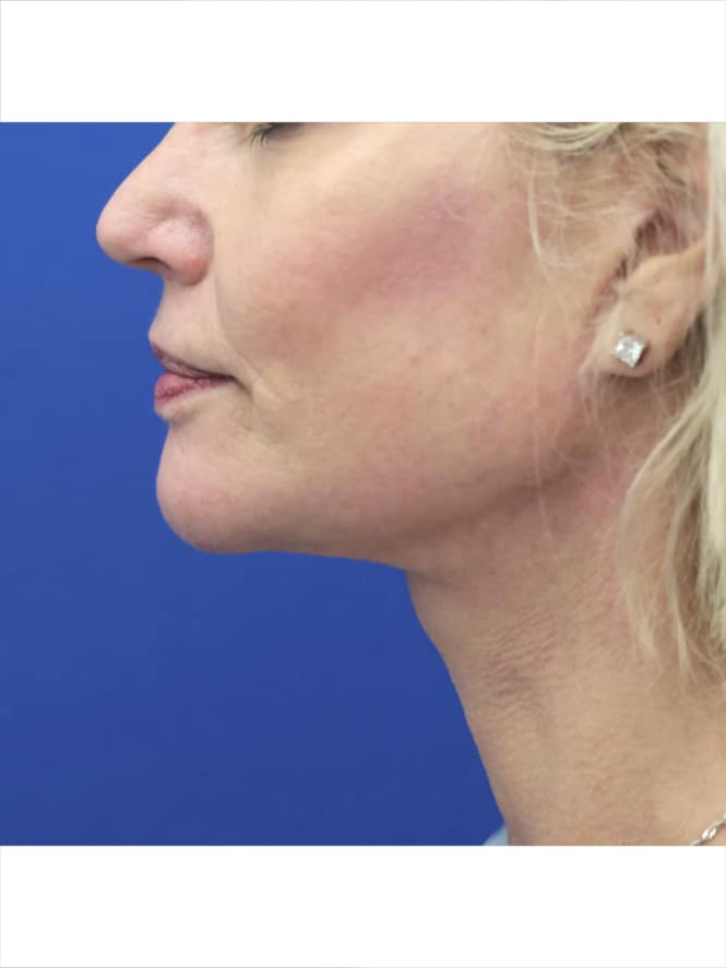 Crisp Profile Lines after photo. Individual results may vary.