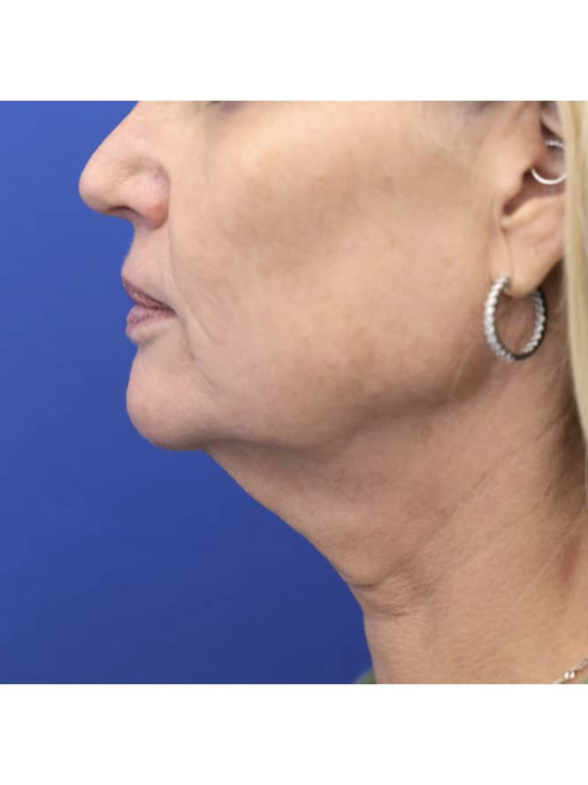 Crisp Profile Lines before photo. Individual results may vary.