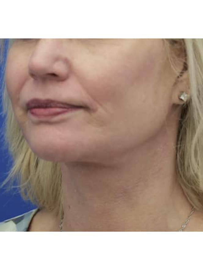 Crisp Profile Lines after photo. Individual results may vary.