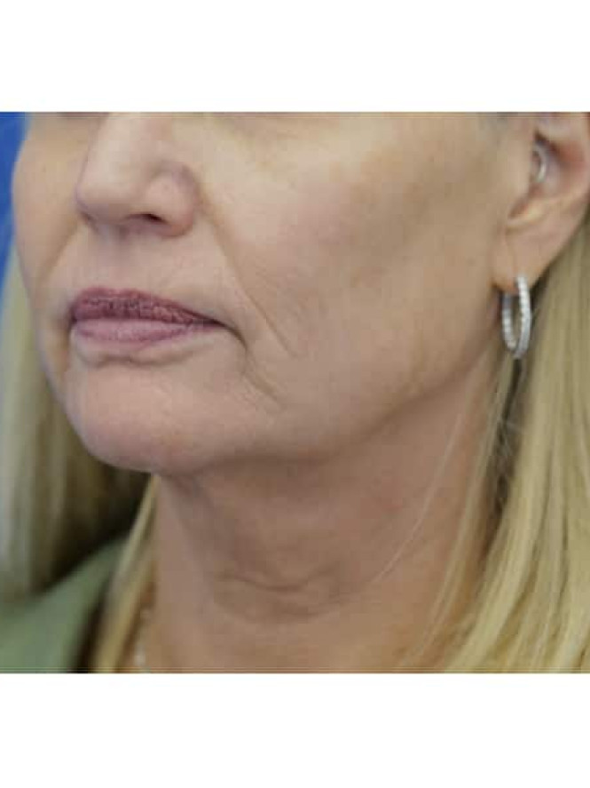 Crisp Profile Lines before photo. Individual results may vary.