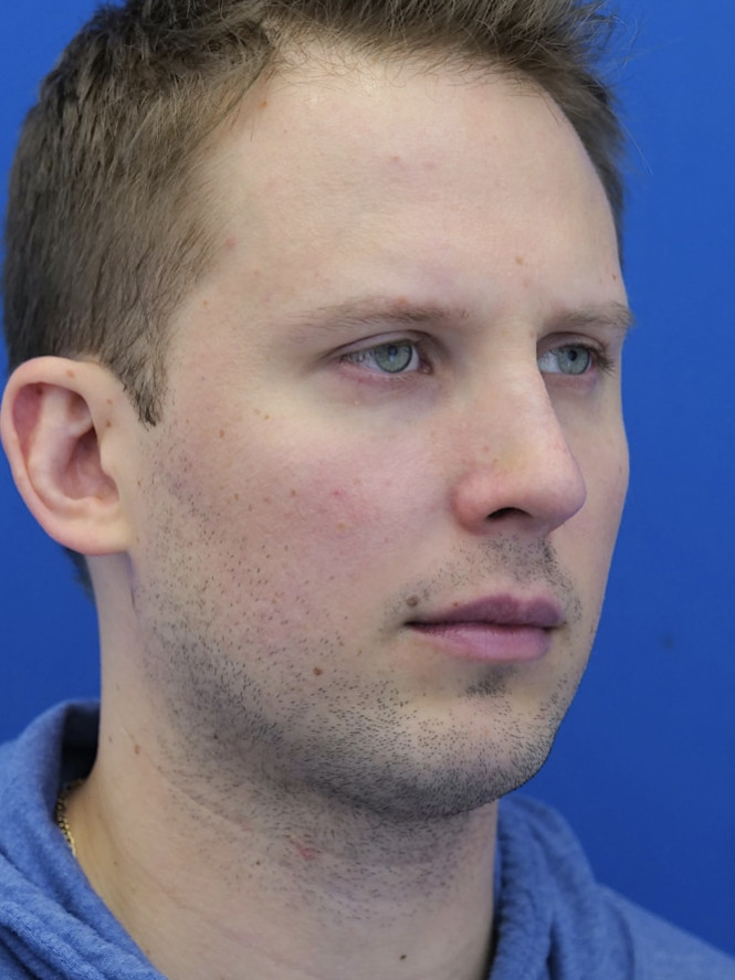 Dorsal Hump and Chin Augmentation after photo. Individual results may vary.