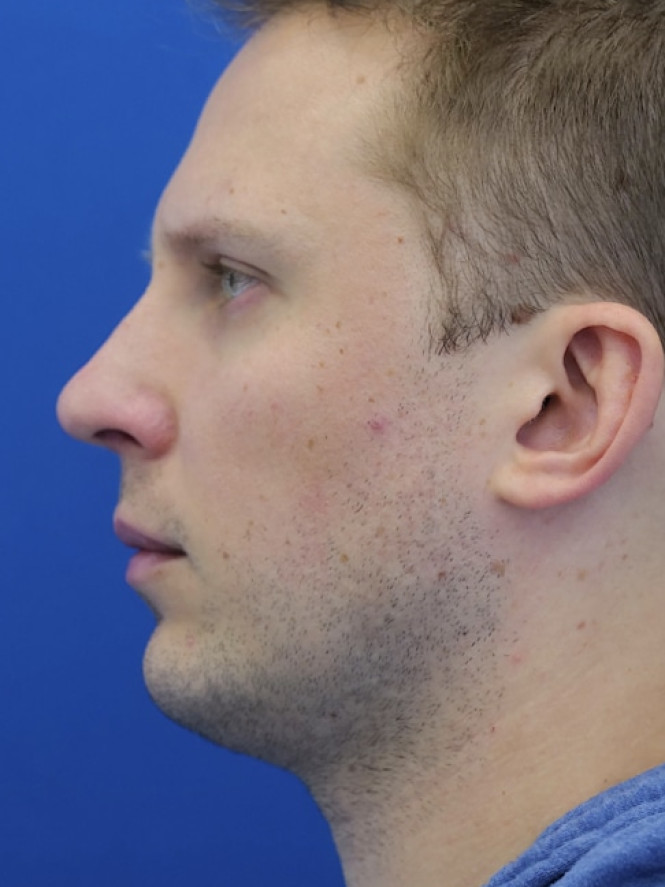 Dorsal Hump and Chin Augmentation after photo. Individual results may vary.