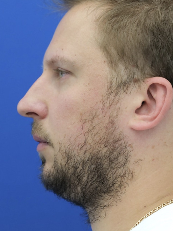 Dorsal Hump and Chin Augmentation before photo. Individual results may vary.