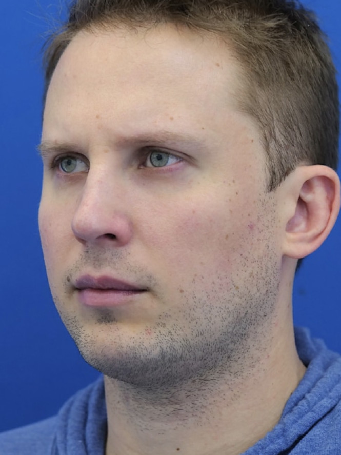 Dorsal Hump and Chin Augmentation after photo. Individual results may vary.