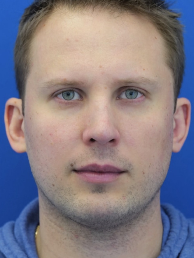 Dorsal Hump and Chin Augmentation after photo. Individual results may vary.
