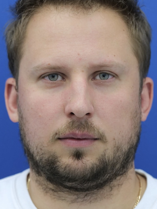 Dorsal Hump and Chin Augmentation before photo. Individual results may vary.