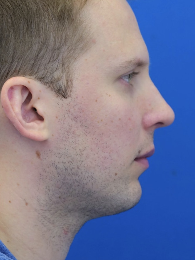 Dorsal Hump and Chin Augmentation
