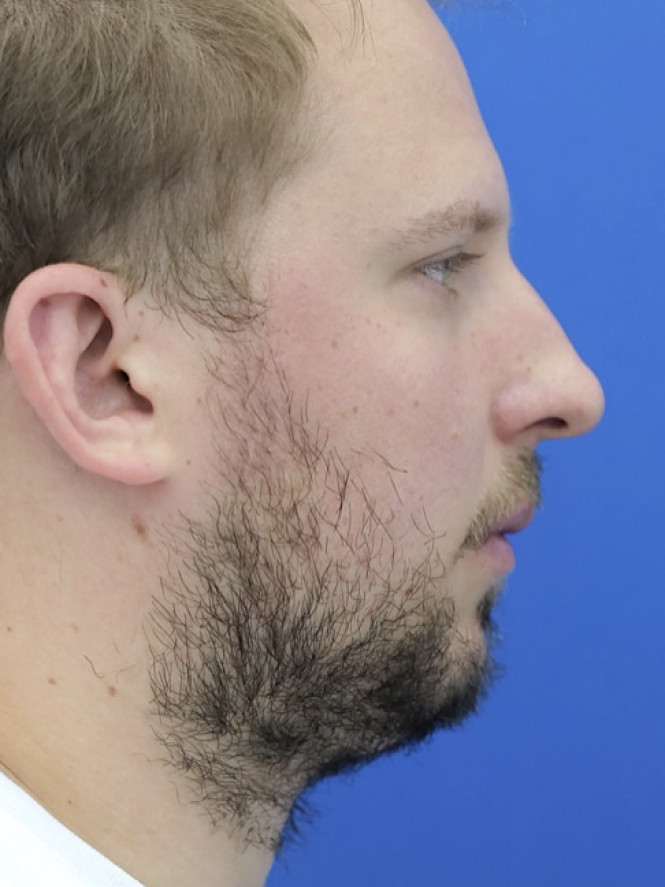 Dorsal Hump and Chin Augmentation